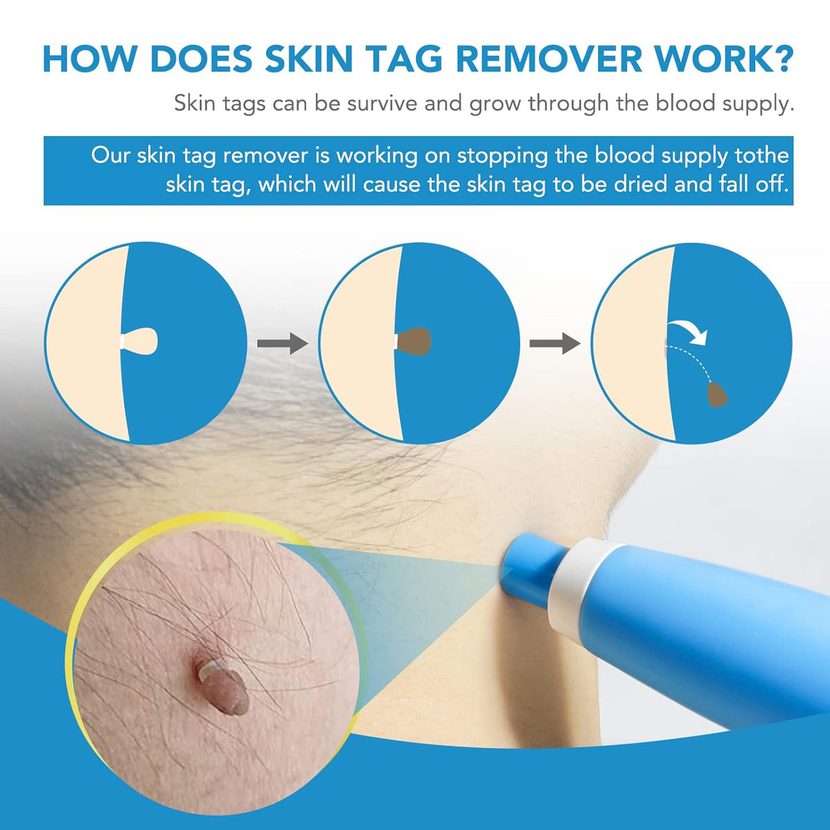 Skin Tag Remover Kit 2 In 1 For Micro To Large (2 Mm - 8 Mm 1 Set) - Happy Price - Image 7