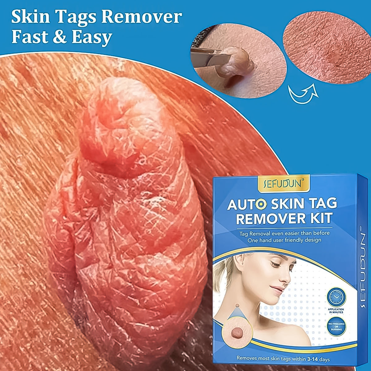 Skin Tag Remover Kit 2 In 1 For Micro To Large (2 Mm - 8 Mm 1 Set) - Happy Price - Image 5