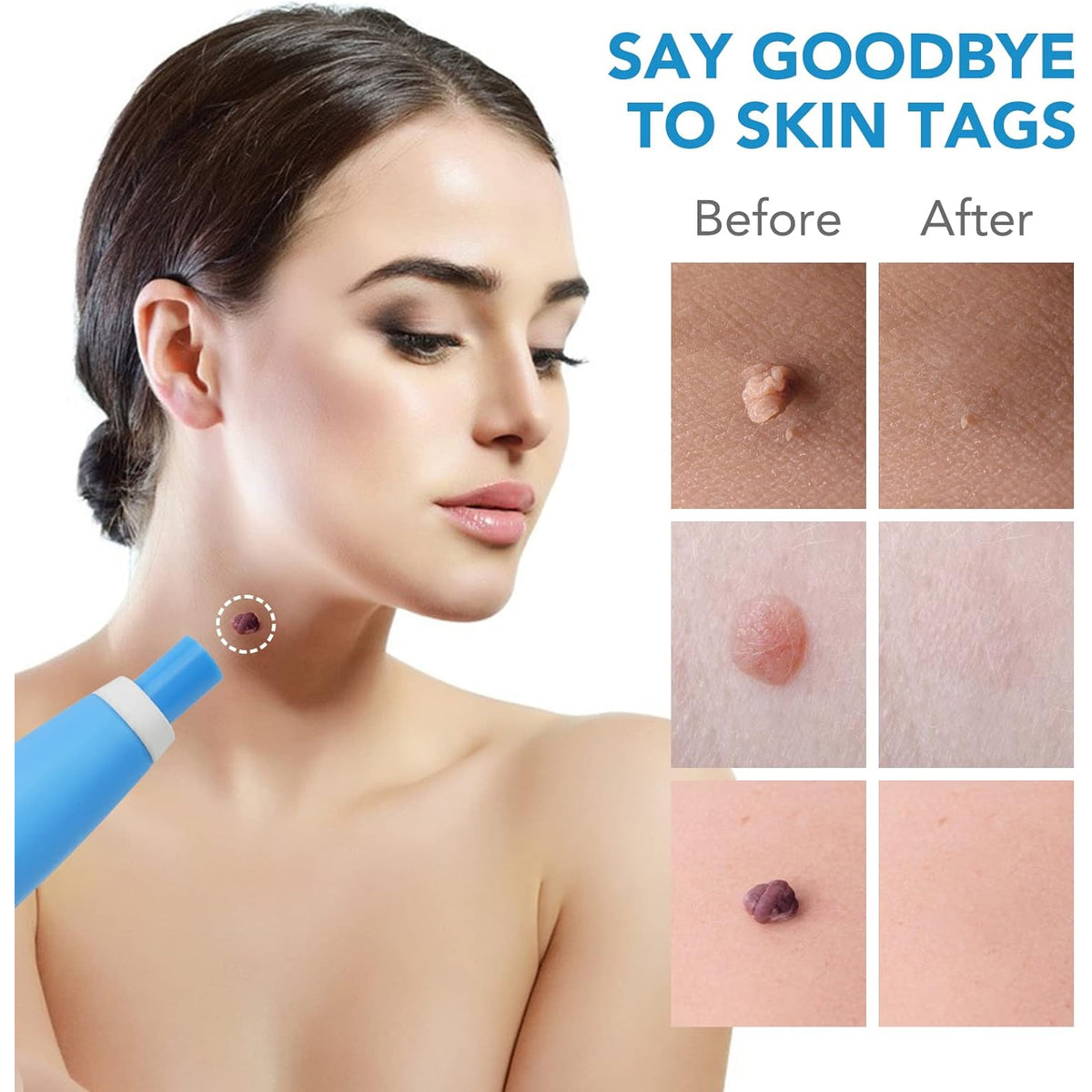 Skin Tag Remover Kit 2 In 1 For Micro To Large (2 Mm - 8 Mm 1 Set) - Happy Price - Image 6