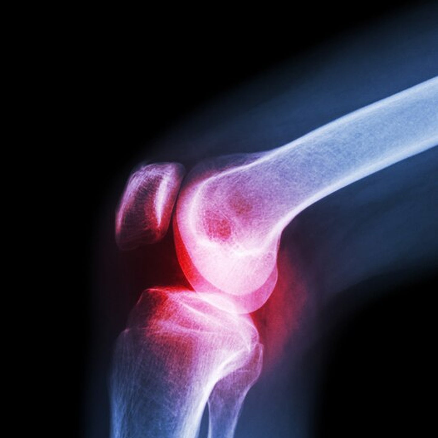 (Xl) Knee Cap For Knee Support - Happy Price - Image 5